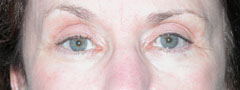 Revision Blepharoplasty - Patient 2 - After